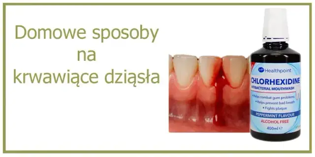 Jaki lek na zapalenie dziąseł? Skuteczne metody i domowe sposoby