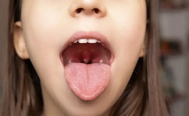 Jak uniknąć anginy? Skuteczna profilaktyka i wzmocnienie odporności