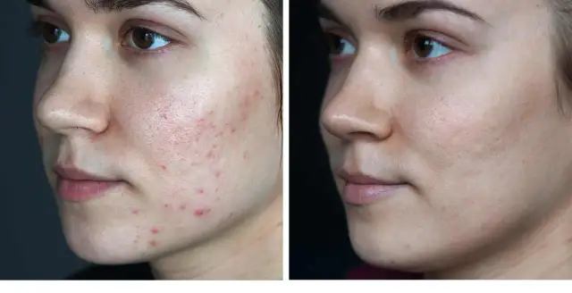 Skuteczne metody na blizny po pryszczach – jak je zredukować?