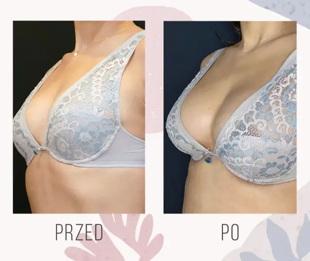 Ile kosztuje powiększenie biustu w Niemczech? Sprawdź, co wpływa na cenę