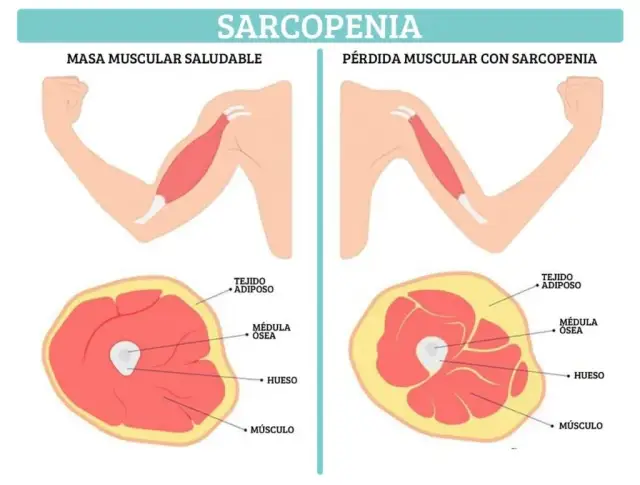 Cómo prevenir la pérdida de masa muscular y mejorar tu calidad de vida