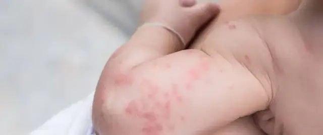 Uczulenie na sierść u niemowląt objawy – jak je rozpoznać i leczyć