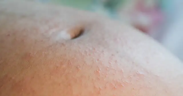 Zbliżenie na brzuch kobiety w ciąży z widocznymi czerwonymi plamkami i wysypką.