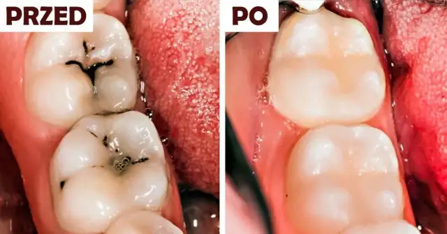 Domowe sposoby na próchnicę: co działa, a kiedy musisz iść do dentysty?