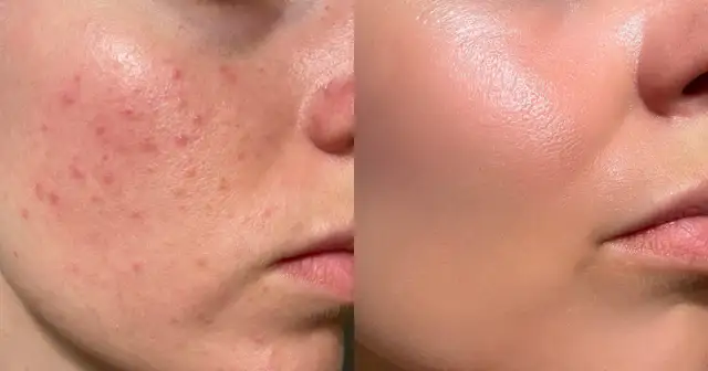 Co jeść na cerę? Dieta, która odmieni Twoją skórę!