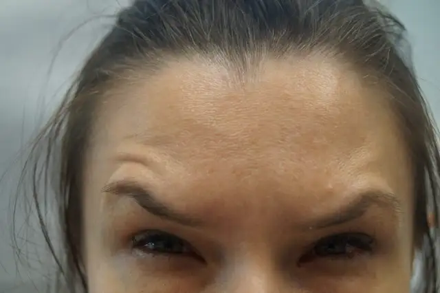 Zbliżenie na czoło i oczy kobiety. Zmarszczki na czole mogą sugerować, czy po botoksie boli głowa.