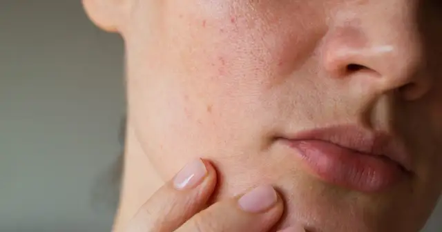 Pryszcz w jedną noc? Szybkie metody na redukcję zaczerwienienia