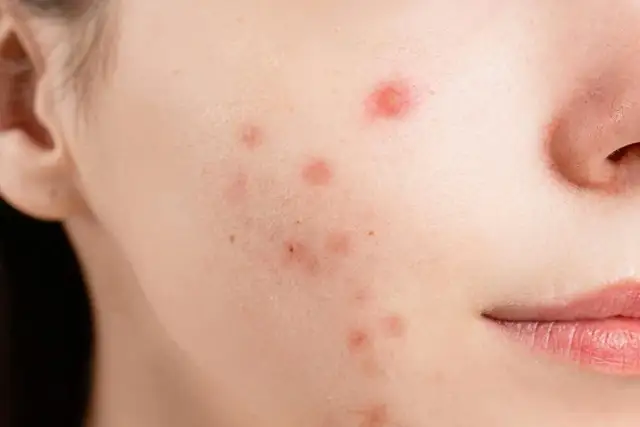 Dermapen efekty - Kiedy widać poprawę i ile zabiegów potrzeba?