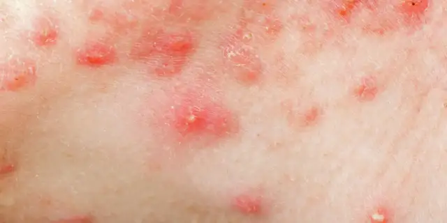 Od czego wychodzą pryszcze? Poznaj przyczyny i sposoby na ich uniknięcie