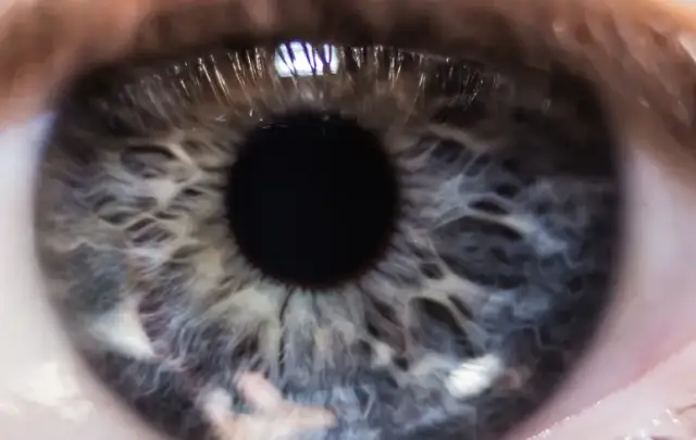 Jak się objawia zaćma? Objawy, które mogą zaskoczyć i zaniepokoić