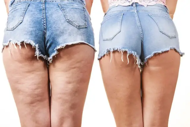 Jak rozbić cellulit na nogach? Kompletny poradnik Adrianny Kaczmarek