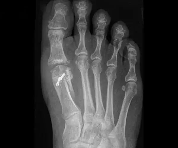 Jak odzyskać sprawność po operacji palucha sztywnego? Przewodnik