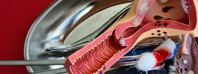 Na czym polega czyszczenie macicy? Poznaj ważne informacje i ryzyka