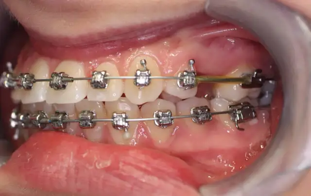 Zbliżenie na zęby z aparatem ortodontycznym, widoczne metalowe zamki i łuki.