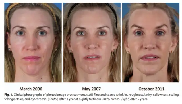 Retinol lek na co? Odkryj jego skuteczność w leczeniu skóry