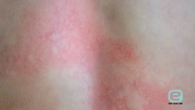 Ugryzienie kleszcza: objawy, rumień, KZM kiedy do lekarza?