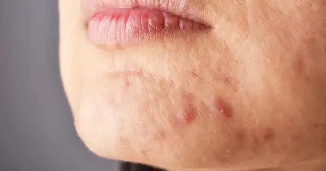 Ile dni przed okresem wyskakują pryszcze i jak ich uniknąć?