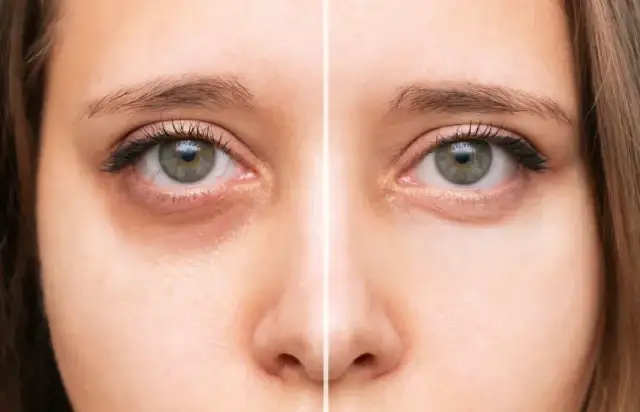 Botoks pod oczy: Kiedy efekty? Pełny rezultat po 10-14 dniach