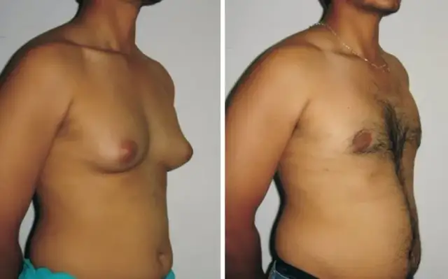 Hormony, które drastycznie zmniejszają piersi. Poznaj prawdziwe powody