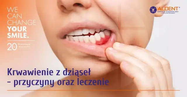 Krwotok z dziąsła? Zatamuj go natychmiast! Przyczyny i porady