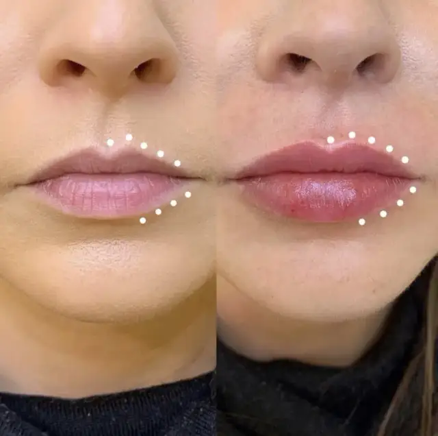 Najlepsze kliniki w Warszawie na zabiegi z kwasem hialuronowym