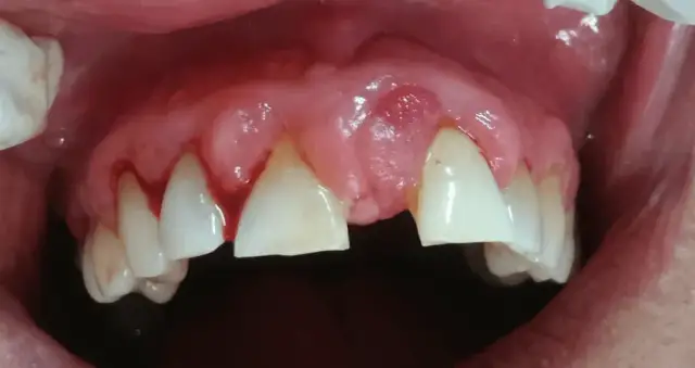 Jaki antybiotyk na zapalenie dziąseł działa najlepiej? opinie i porady