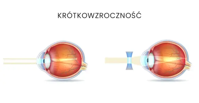 Jak wyleczyć krótkowzroczność i poprawić jakość widzenia?