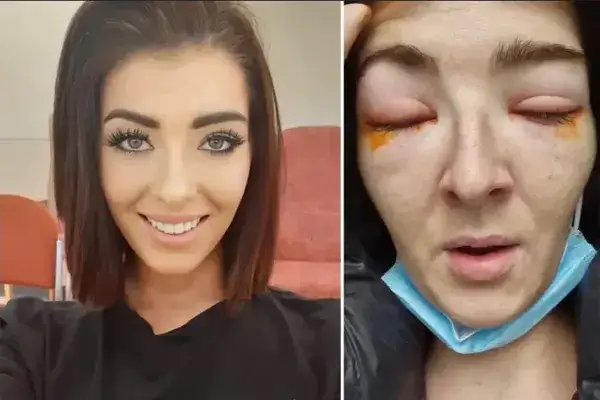 Alergia na rzęsy po przedłużaniu? Rozpoznaj objawy i działaj!