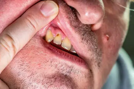 Jak usunąć ropę z dziąsła i uniknąć poważnych komplikacji zdrowotnych