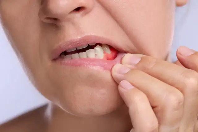 Osoba dotyka palcem zaczerwienionych, opuchniętych dziąseł, co wskazuje na stan zapalny dziąseł.