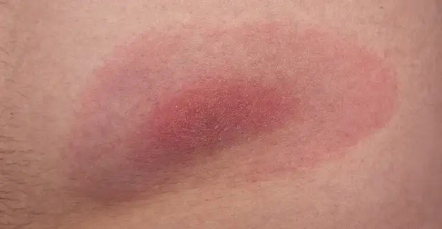 Rumień po kleszczu: Jak długo się utrzymuje? Odczyn czy borelioza?