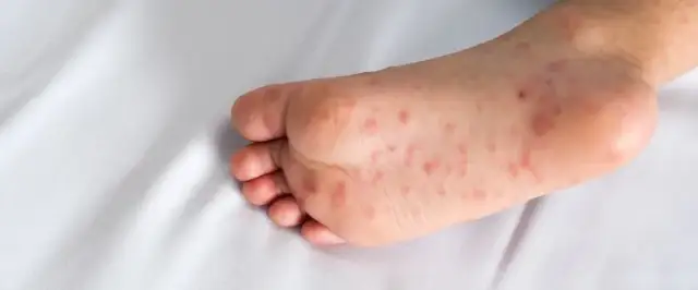 Leczenie Bostonki: Jak złagodzić objawy u dzieci i dorosłych?