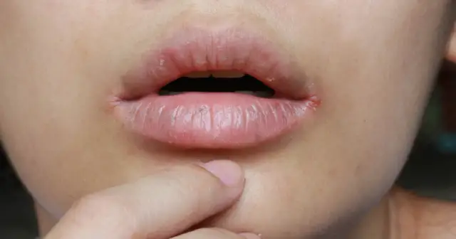 Objawy niedoborów witamin w ustach. Co mówią Twoje dziąsła i język?