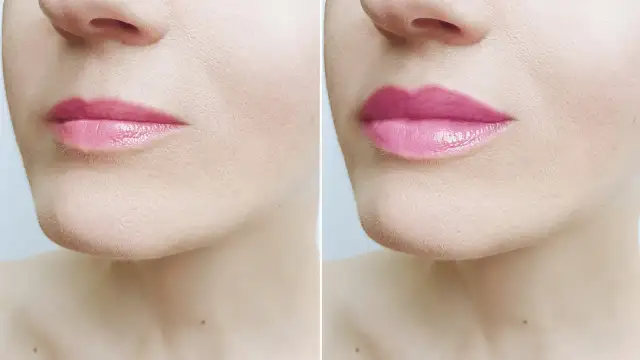 Botoks na usta: 3-4 miesiące? Sprawdź, co wpływa na trwałość!