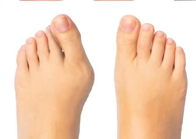 Zrośnięte palce u stóp: przyczyny, rodzaje i metody leczenia
