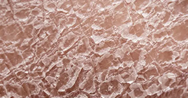 Metotreksat: Skutki uboczne? Poznaj prawdę i chroń swoje zdrowie