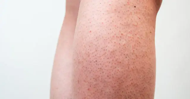 Jak skutecznie pozbyć się czerwonych kropek po goleniu i uniknąć bólu