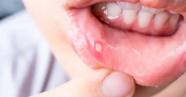 Widoczne białe owrzodzenie na czerwonym, opuchniętym policzku. To duża afta, która sprawia ból.