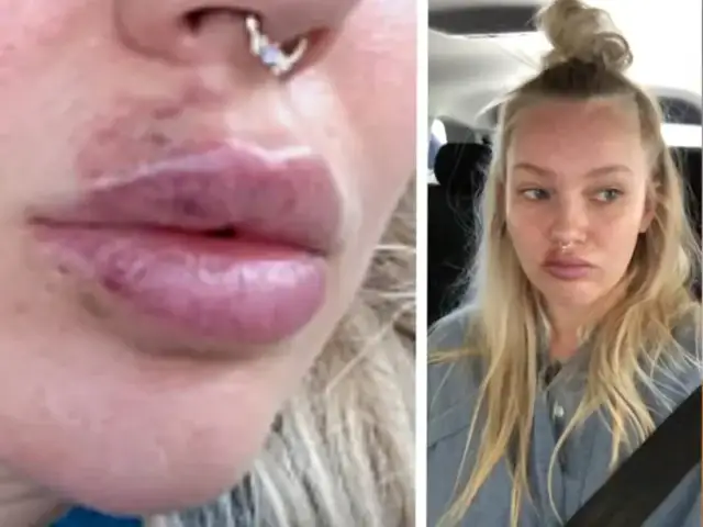 Jak wygląda martwica ust po kwasie hialuronowym? Objawy i zagrożenia