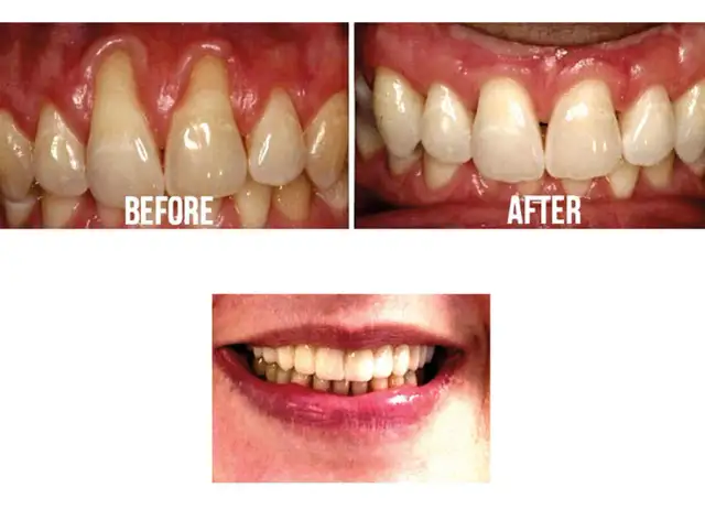 Recesja dziąseł: 7 objawów, których nie wolno ignorować. Sprawdź!