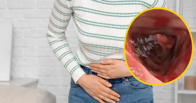 Zapalenie jelit: Objawy, różnice i kiedy do lekarza?