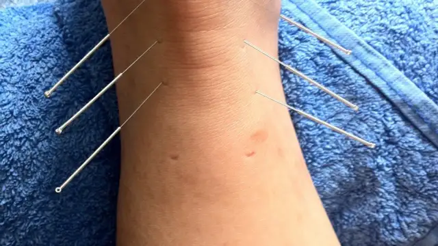 Igły do akupunktury: Jak wybrać najlepsze dla Twojego gabinetu?