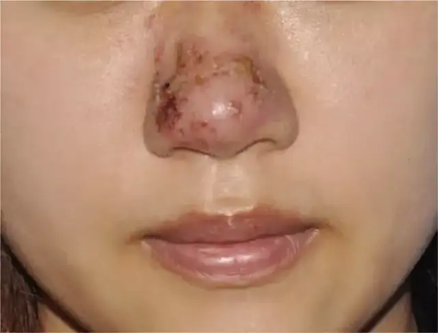 Biofilm po kwasie hialuronowym objawy: jak uniknąć powikłań?