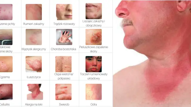 Jak wygląda alergia skórna zdjęcia – poznaj objawy i ich wygląd