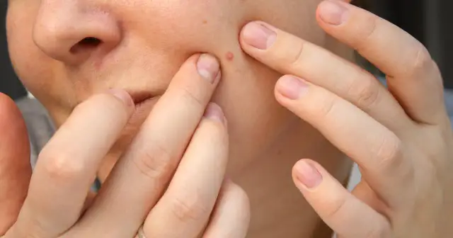 Zbliżenie na twarz z widocznym zaczerwienionym pryszczem, dotykanym palcami.