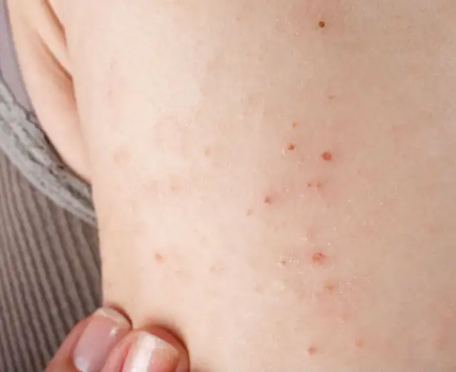 Jak długo trwa alergia polekowa? Objawy, leczenie i czas trwania