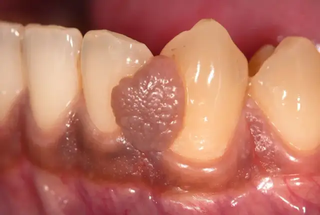 Jak zmniejszyć opuchliznę dziąsła i uniknąć bólu w jamie ustnej