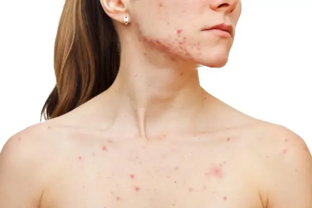 Jak skutecznie leczyć pryszcze po sterydach i odzyskać zdrową skórę