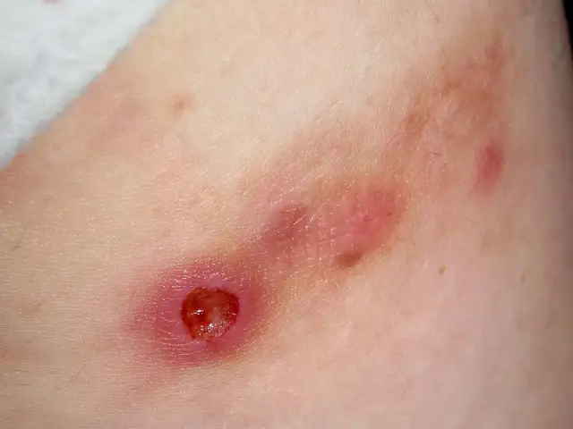 Rana po pryszczu: Jak szybko i bez śladów ją wyleczyć?