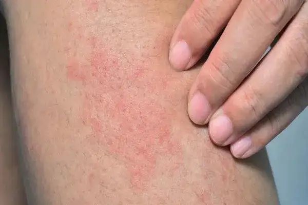 Masz krostki na nogach? Oto przyczyny i jak mieć gładką skórę